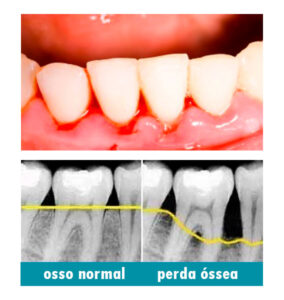 Doença Periodontal